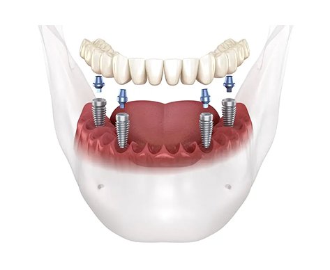 Full-arch implant components